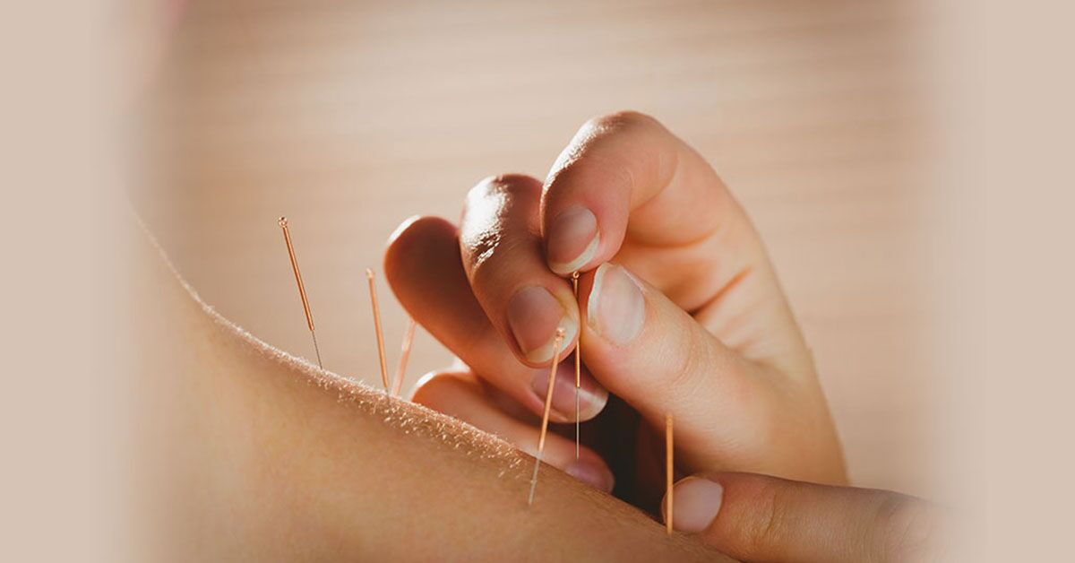Acupuncture